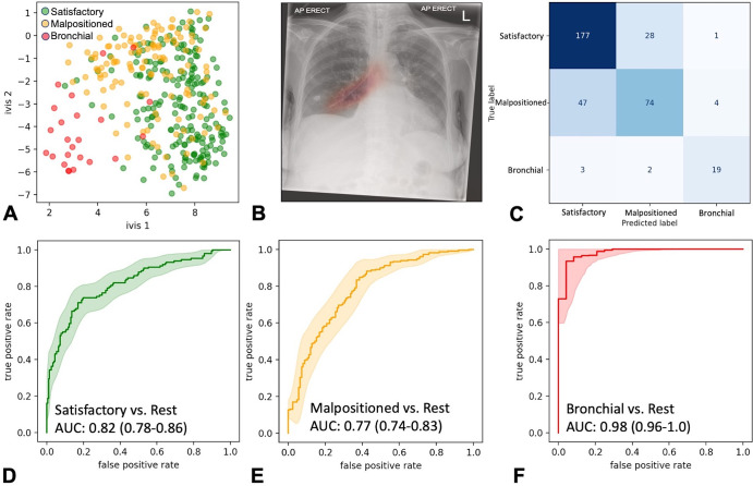 Ensemble performance for nasogastric tube (NGT) malposition detection on the testing set (355 images). (A) Scatterplot shows two-dimensional twin neural network (Ivis) embedding of the combined global average pooling layer values in the NGT malposition ensemble. Each point represents a single chest radiograph in the testing set. Green, orange, and red points reflect satisfactory, malpositioned, and bronchial NGT ground truth values, respectively. (B) Heatmap shows gradient-weighted class activation mapping activation of the final convolutional layer in the 1024 × 1024 InceptionV3 model superimposed over a bronchial-positioned NGT. (C) Ensemble confusion matrix between ground truths and predicted image labels. Predicted labels reflect the class with the greatest classification probability. (D–F) Receiver operating characteristic curves for each class of interest. Shaded areas are 95% CIs, generated using 2000 bootstrapped samples. AP = anteroposterior, AUC = area under the receiver operating characteristic curve.