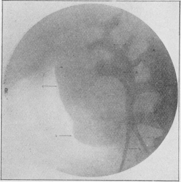 Case III