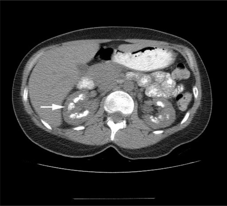 Image Diagnosis: Medullary Sponge Kidney - PMC