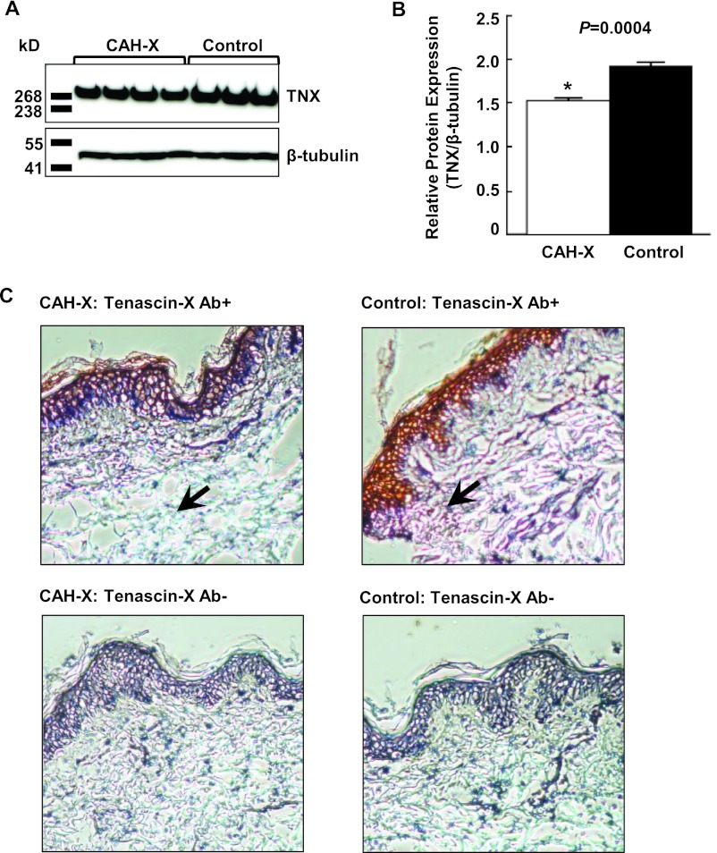 Tenascin-X Haploinsufficiency Associated with Ehlers-Danlos Syndrome in ...