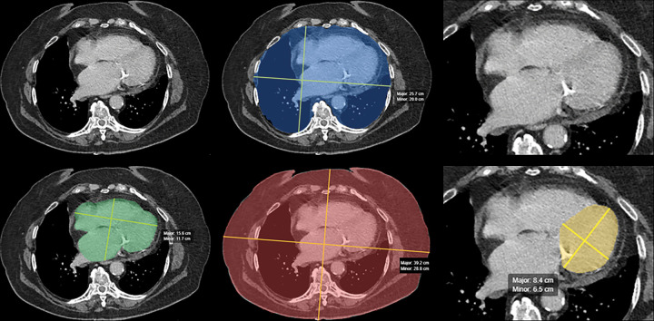 Automated artificial intelligence (AI) algorithm for opportunistic screening of cardiomegaly. Panel of images from contrast-enhanced CT in a 58-year-old man undergoing surveillance for previously resected right renal cell carcinoma. The AI algorithm performed two-dimensional segmentation of the whole heart (lower left, green), inner chest (upper middle, blue), outer chest (lower middle, red), and left ventricle (lower right, yellow). Original full-view (upper left) and ×2 magnified (upper right) images are included for comparison. Area of the inner and outer chest, as well as patient age and sex, are used to standardize the whole-heart and left ventricular measurements to best identify cardiomegaly. (Images courtesy of Andrew D. Smith, MD, University of Alabama at Birmingham.)