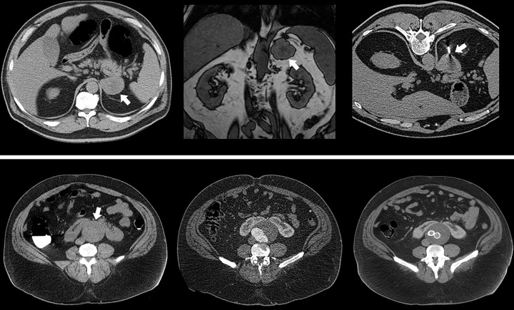 Opportunistic detection of extracolonic pathologic findings at CT colonography (CTC) screening. Top row: Supine image from CTC screening in an asymptomatic 63-year-old man (left) shows an unsuspected 5.5-cm left adrenal mass (arrow), which measured 27 HU (indeterminate). Subsequent contrast-enhanced CT scan (not shown) with adrenal protocol showed little or no washout (<10%). On opposed-phase chemical shift MRI scan (middle), the adrenal mass (arrow) fails to show signal dropout. Subsequent CT-guided core needle biopsy (right, arrow) was suggestive of adrenocortical carcinoma, which was confirmed after adrenalectomy with negative margins. The patient is doing well without evidence of disease over 13 years later. Bottom row: Supine image from CTC screening in an asymptomatic 52-year-old man (left) shows an unsuspected infrarenal abdominal aortic aneurysm (arrow) that measured up to 6.8 cm in anteroposterior diameter, as well as a horseshoe kidney that was previously unknown. Subsequent work-up included CT angiography (middle) within a week and aortoiliac stent graft repair (right) within 1 month of the acquisition of the CTC image. The patient is alive and well 14 years later.