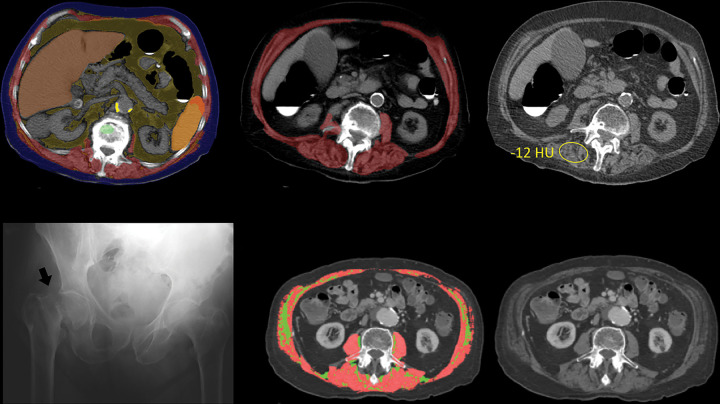 Myosteatosis with subsequent hip fracture in an 87-year-old woman. Top row: Composite L1-level CT image (left) and L3-level CT image with (middle) and without (right) automated muscle overlay show sarcopenia, with intermuscular adipose tissue most notably involving the paraspinal musculature. Automated mean muscle attenuation measured –10 HU, similar to the manual measurement (–12 HU). See Figure 1 for the color key. Bottom row: The patient experienced a femoral neck fracture 3 years later as shown on anteroposterior radiograph of pelvis (left, arrow) and died 3 years after that. L3-level CT images (middle and right) from another patient using a different automated algorithm show separate segmentation of skeletal muscle (pink) and intermuscular adipose tissue (green). Results for myosteatosis (in Hounsfield units) and myopenia (area) are dependent on how a specific muscle algorithm handles intermuscular adipose tissue. (Images from the second patient courtesy of Akshay Chaudhari, PhD, and Robert D. Boutin, MD, Stanford University.)