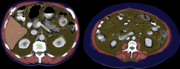 Sarcopenic obesity in two patients with colorectal cancer. CT images in a 79-year-old man (left) and 69-year-old woman (right) with automated body composition tools applied show abundance of visceral fat and myosteatosis (L3-level muscle attenuation was <10 HU for both patients). However, the amount of subcutaneous fat differs substantially between the two patients. Conflicting data exist on whether abdominal fat is protective or detrimental, and may depend on the specific compartment (visceral vs subcutaneous). See Figure 1 for the color key.