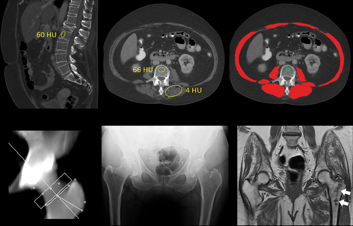 Unsuspected osteoporosis and sarcopenia (osteosarcopenic obesity) in a 58-year-old woman with subsequent hip fracture. Top row: Sagittal (left) and L3-level transverse (middle) images from CT examination for unexplained abdominal pain show a prevalent L1 compression fracture and associated low bone mineral density (BMD) (L2 region of interest [ROI]), compatible with complicated osteoporosis. The same transverse L3-level image (right) shows superimposition of automated BMD (green) and muscle (red) segmentations, with mean muscle attenuation of 2 HU, comparing well with the manual paraspinal ROI (4 HU). Bottom row: Retrospective quantitative CT image (left) shows an osteoporotic femoral neck T-score of –2.9, but central dual-energy x-ray absorptiometry examination 2 years later (not shown) was falsely negative for osteoporosis and also missed the L1 compression. The patient presented 3 months later with hip pain. Initial pelvic radiograph (middle) was negative, but an MRI examination later that day (right) revealed a trochanteric fracture with extension into the metaphysis (arrows), which required internal fixation. Note also generalized sarcopenia at MRI.