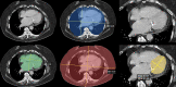 Automated artificial intelligence (AI) algorithm for opportunistic
screening of cardiomegaly. Panel of images from contrast-enhanced CT in a
58-year-old man undergoing surveillance for previously resected right renal cell
carcinoma. The AI algorithm performed two-dimensional segmentation of the whole
heart (lower left, green), inner chest (upper middle, blue), outer chest (lower
middle, red), and left ventricle (lower right, yellow). Original full-view
(upper left) and ×2 magnified (upper right) images are included for
comparison. Area of the inner and outer chest, as well as patient age and sex,
are used to standardize the whole-heart and left ventricular measurements to
best identify cardiomegaly. (Images courtesy of Andrew D. Smith, MD, University
of Alabama at Birmingham.)
