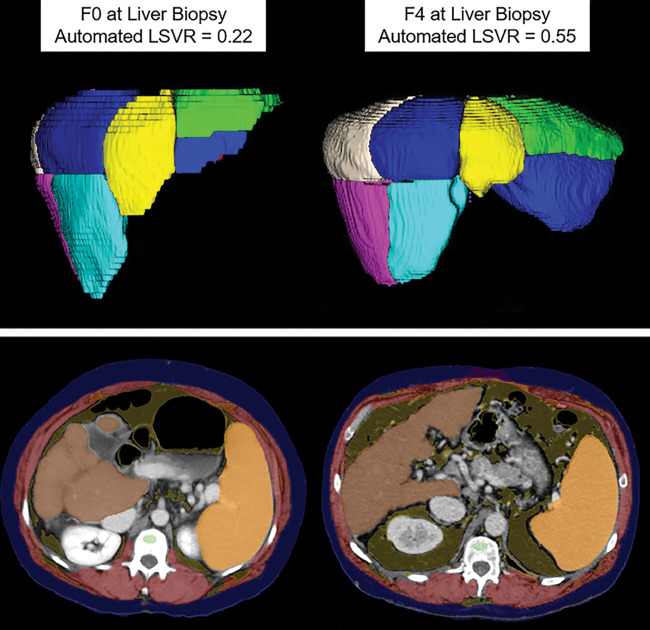 Automated tools for assessing liver fibrosis, cirrhosis, and portal hypertension. Top row: Images from fully automated Couinaud segmentation of the liver in a 45-year-old man (left) and 60-year-old man (right), both with hepatitis C virus, who had fibrosis scores of F0 and F4, respectively, at liver biopsy. Note the relative compensation of the left lateral segments (II and III) in the cirrhotic patient, compatible with segmental redistribution. This is also reflected in more quantitative terms by the elevated liver segmental volume ratio (LSVR), which objectively compares Couinaud segments I–III over IV–VIII. Bottom row: Upper abdominal transverse CT images in two patients with compensated cirrhosis (49-year-old woman with alcoholic cirrhosis on left, 50-year-old man with hepatitis C virus cirrhosis on right) again show composite depictions of the automated body composition tools, which demonstrate splenomegaly. Automated splenic volumes (1092 mL and 985 mL, respectively) matched semiautomated derivation within 10% in both patients. As with liver segmental volume ratio, splenic volume correlates with pathologic stage of liver fibrosis, and the two measures are actually complementary. For the bottom row, see Figure 1 for the color key. (Top row images courtesy of Sungwon Lee, MD, PhD.)