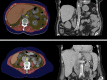 Automated quantification of aortic atherosclerotic calcification. Top row:
Transverse (left) and coronal (right) noncontrast CT images in an 89-year-old
woman show extensive aortoiliac calcification, which has been automatically
segmented (bright yellow). The patient experienced a myocardial infarction 3
years later and died within a year after that. Note also the abundant visceral
fat. Bottom row: Transverse (left) and coronal (right) postcontrast CT images in
an 80-year-old woman also show extensive calcified aortic plaque. This patient
also experienced a myocardial infarction and subsequently died. Note how the
automated algorithm correctly segmented the aortic calcification despite luminal
contrast enhancement. For both patients, the aortic Agatston score was markedly
elevated. See Figure 1 for the color key.