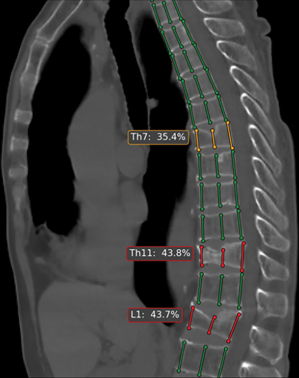 Automated tool for detection of vertebral compression fractures. Sagittal image from chest CT shows automated spine segmentation tracking vertebral height (colored lines) obtained with a dedicated artificial intelligence tool (AI Genant, IRA analysis). Compression fractures with 25%–40% height loss are depicted in yellow and more severe compressions (>40%) in red. (Image courtesy of Alexey Petraikin, MD, PhD, Moscow Laboratory of Innovation Technologies. See https://mosmed.ai/en/ for general information about the Moscow project “Artificial intelligence in radiology.”)