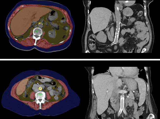 Automated quantification of aortic atherosclerotic calcification. Top row: Transverse (left) and coronal (right) noncontrast CT images in an 89-year-old woman show extensive aortoiliac calcification, which has been automatically segmented (bright yellow). The patient experienced a myocardial infarction 3 years later and died within a year after that. Note also the abundant visceral fat. Bottom row: Transverse (left) and coronal (right) postcontrast CT images in an 80-year-old woman also show extensive calcified aortic plaque. This patient also experienced a myocardial infarction and subsequently died. Note how the automated algorithm correctly segmented the aortic calcification despite luminal contrast enhancement. For both patients, the aortic Agatston score was markedly elevated. See Figure 1 for the color key.