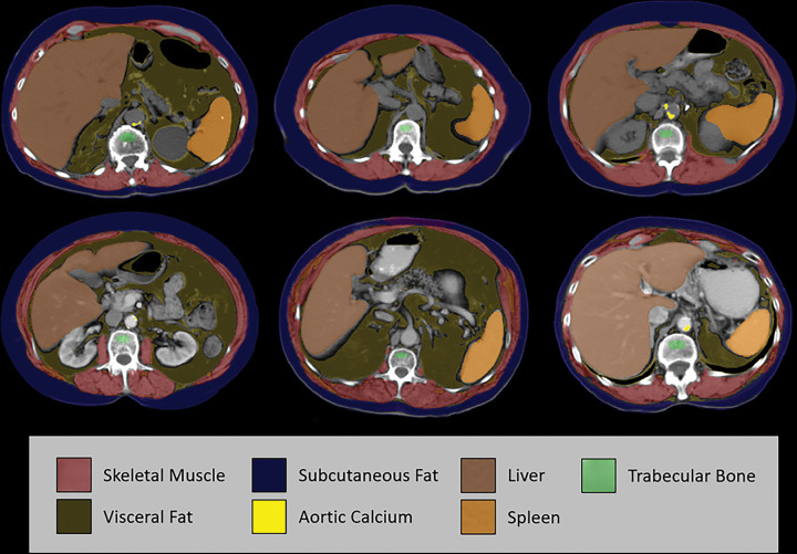 Case examples of fully automated CT-based body composition measures from six different older adult patients (over 60 years of age). Noncontrast (top row) and postcontrast (bottom row) CT images at the L1 vertebral level demonstrate artificial intelligence–based segmentation of skeletal muscle, visceral fat, subcutaneous fat, aortic calcium, liver, and spleen. The green region of interest is intended for assessment of trabecular bone mineral density. These visual correlates allow for rapid quality assurance for correct tissue segmentation, although multisection review would be needed to fully confirm some measures. In addition, some adjustments are indicated to correct for the effect of intravenous contrast media on certain measures. Use of the L1 level for bone, fat, and muscle assessment allow for use of both abdominal and chest CT examinations. Note that automated algorithms for segmenting the pancreas, kidneys, and other structures exist but are not depicted here.