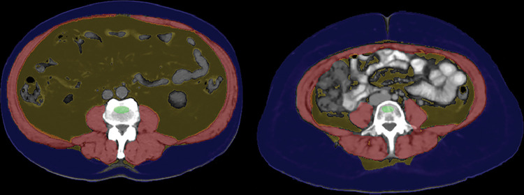 Differences in visceral and subcutaneous fat distribution (apple vs pear body habitus). Midabdominal CT image with automated body composition overlays in an 81-year-old man (left) shows an abundance of visceral fat relative to subcutaneous fat, corresponding to a high visceral to subcutaneous fat ratio, as well as the so-called apple-shaped body habitus. In contrast, CT image from a 34-year-old woman (right) shows a disproportionate amount of subcutaneous fat (pear-shaped). The patient on the right had a higher body mass index, or BMI (35 kg/m2), than the patient on the left (31 kg/m2), who later experienced a myocardial infarction and subsequently died of metabolic syndrome–related issues. See Figure 1 for the color key.