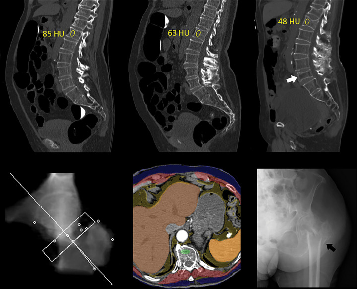 Unsuspected osteoporosis in an asymptomatic 74-year-old woman with subsequent hip fracture and death. Top row: Sagittal images from CT colonography (CTC) screening in 2005 (left) and 2010 (middle) show progressive bone loss, with L1 trabecular attenuation values of 85 HU and 63 HU, respectively. Sagittal image from subsequent CT in 2012 (right) shows further bone loss at L1 (48 HU), as well as multiple new vertebral compression fractures, most notably at L5 (arrow). Bottom row: Both dual-energy x-ray absorptiometry (not shown) and quantitative CT (left) T-scores were falsely negative for osteoporosis. Composite body composition image (middle, similar to Fig 1) from 2012 shows advanced osteosarcopenia. The patient experienced an intertrochanteric femoral fracture as shown on anteroposterior left hip radiograph (right, arrow) later that year and died in 2016.