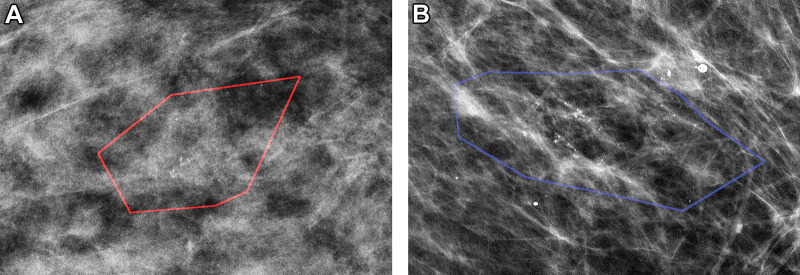 Mammographic images of patients with biopsy-proven ductal carcinoma in situ (DCIS). (A) A 55-year-old woman (right magnification craniocaudal view) diagnosed with DCIS only; model correctly classified as negative findings. (B) A 64-year-old woman (left magnification mediolateral oblique view) with DCIS at core biopsy but subsequently upstaged to invasive disease; model correctly classified as positive findings. Red and blue polygons show lesions annotated by the radiologist.