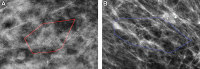 Mammographic images of patients with biopsy-proven ductal carcinoma in
situ (DCIS). (A) A 55-year-old woman (right magnification craniocaudal view)
diagnosed with DCIS only; model correctly classified as negative findings.
(B) A 64-year-old woman (left magnification mediolateral oblique view) with
DCIS at core biopsy but subsequently upstaged to invasive disease; model
correctly classified as positive findings. Red and blue polygons show
lesions annotated by the radiologist.