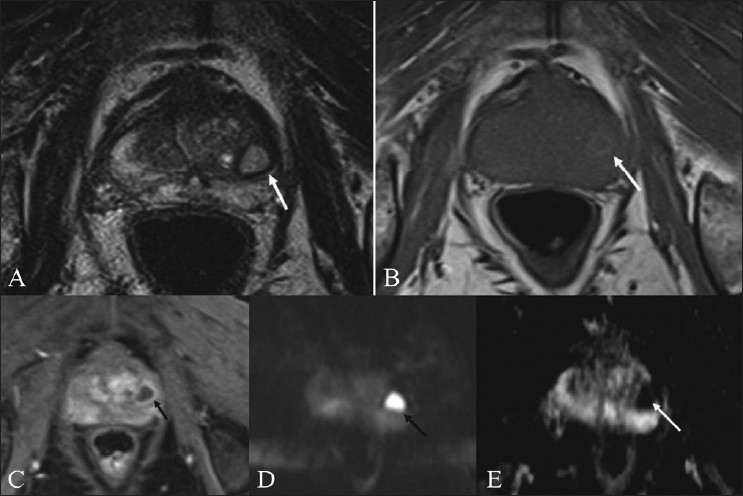 Case series: Diffusion weighted MRI appearance in prostatic abscess - PMC