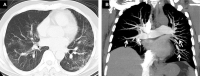 Thoracic CT angiography of a 42-year-old patient with positive PCR for COVID-19. Parenchymal window in the axial section (A) without injection shows peripheral bilateral ‘ground glass’ areas (arrow). The mediastinal window (B) in coronal reconstruction (MIP), reveals several bilateral endoluminal defects involving the lobar, segmental, and sub-segmental branches of the pulmonary artery (arrow)