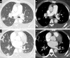 Chest CT-angiography of a 38-year-old patient with no pathological history with a positive PCR for COVID-19 pneumonia. Parenchymal window (A, C) shows peripheral foci of condensation. Mediastinal window (B, D) finds a bilateral proximal pulmonary embolism (endoluminal defects at the bilateral lobar level) as well as a left pleural effusion