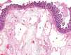 Nonenhanced (a) axial and (b) coronal CT performed in a 54-year-old man shows pneumatosis cystoides intestinalis (white arrows) in a long segment of ileum. Adjacent mesenteric congestion is also noted (black arrow). Laparotomy shows no frank bowel necrosis. (c) A low-power photomicrograph of the ileum shows ischemic degenerative changes of the mucosa, with villous blunting (left) and withered crypts. There is marked submucosal edema with large empty spaces, consistent with pneumatosis (*). (Hematoxylin-eosin stain; original magnification, ×40.) (d) A high-power view of the superficial submucosa shows arterioles with fibrin thrombi (arrowheads) beneath the damaged mucosa. (Hematoxylin-eosin stain; original magnification, ×40.)