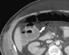 (a) Abdominal US obtained because of elevated liver enzyme level in a 34-year-old man incidentally shows peripheral echogenic branching foci (arrow) with dirty shadowing (*), in keeping with portal venous gas. (b) Subsequent CT image of the abdomen and pelvis with intravenous contrast material enabled confirmation of portal venous gas and shows gas in the transverse mesocolon vasculature (arrow). At laparotomy, patchy areas of yellow discoloration of uncertain origin are identified on the antimesenteric aspect of the transverse colon. Second-look laparotomy shows yellow discoloration of the stomach and no ischemia.