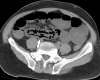 Nonenhanced (a) axial and (b) coronal CT performed in a 54-year-old man shows pneumatosis cystoides intestinalis (white arrows) in a long segment of ileum. Adjacent mesenteric congestion is also noted (black arrow). Laparotomy shows no frank bowel necrosis. (c) A low-power photomicrograph of the ileum shows ischemic degenerative changes of the mucosa, with villous blunting (left) and withered crypts. There is marked submucosal edema with large empty spaces, consistent with pneumatosis (*). (Hematoxylin-eosin stain; original magnification, ×40.) (d) A high-power view of the superficial submucosa shows arterioles with fibrin thrombi (arrowheads) beneath the damaged mucosa. (Hematoxylin-eosin stain; original magnification, ×40.)