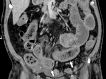 (a) Axial and (b) coronal CT images of the abdomen and pelvis with intravenous contrast material in a 57-year-old man with high clinical suspicion for bowel ischemia. There is generalized small-bowel distension and segmental thickening (white arrows), with adjacent mesenteric congestion (black arrow) and a small volume of ascites (*). Findings are nonspecific but suggestive of early ischemia or infection.