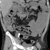 Nonenhanced (a) axial and (b) coronal CT performed in a 54-year-old man shows pneumatosis cystoides intestinalis (white arrows) in a long segment of ileum. Adjacent mesenteric congestion is also noted (black arrow). Laparotomy shows no frank bowel necrosis. (c) A low-power photomicrograph of the ileum shows ischemic degenerative changes of the mucosa, with villous blunting (left) and withered crypts. There is marked submucosal edema with large empty spaces, consistent with pneumatosis (*). (Hematoxylin-eosin stain; original magnification, ×40.) (d) A high-power view of the superficial submucosa shows arterioles with fibrin thrombi (arrowheads) beneath the damaged mucosa. (Hematoxylin-eosin stain; original magnification, ×40.)