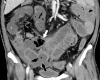 (a) Coronal CT image of the abdomen and pelvis with intravenous contrast material in a 47-year-old man with abdominal tenderness shows typical findings of mesenteric ischemia and infarction, including pneumatosis intestinalis (white arrow) and nonenhancing bowel (*). Frank discontinuity of a thickened loop of small bowel in the pelvis (black arrow) is in keeping with perforation. (b) These findings are confirmed at laparotomy, with the additional observation of an atypical yellow discoloration of the bowel.