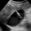 (a) Abdominal US image of an 83-year-old man with an elevated liver enzyme level and sepsis shows a distended gallbladder (arrows) containing sludge (*), suggestive of cholestasis. (b) Intraprocedural US image shows a needle within the gallbladder lumen (arrow), while a cholecystostomy tube is placed with US guidance. Fluid analysis reveals noninfected bile.