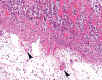 Nonenhanced (a) axial and (b) coronal CT performed in a 54-year-old man shows pneumatosis cystoides intestinalis (white arrows) in a long segment of ileum. Adjacent mesenteric congestion is also noted (black arrow). Laparotomy shows no frank bowel necrosis. (c) A low-power photomicrograph of the ileum shows ischemic degenerative changes of the mucosa, with villous blunting (left) and withered crypts. There is marked submucosal edema with large empty spaces, consistent with pneumatosis (*). (Hematoxylin-eosin stain; original magnification, ×40.) (d) A high-power view of the superficial submucosa shows arterioles with fibrin thrombi (arrowheads) beneath the damaged mucosa. (Hematoxylin-eosin stain; original magnification, ×40.)