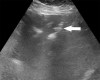 (a) Abdominal US obtained because of elevated liver enzyme level in a 34-year-old man incidentally shows peripheral echogenic branching foci (arrow) with dirty shadowing (*), in keeping with portal venous gas. (b) Subsequent CT image of the abdomen and pelvis with intravenous contrast material enabled confirmation of portal venous gas and shows gas in the transverse mesocolon vasculature (arrow). At laparotomy, patchy areas of yellow discoloration of uncertain origin are identified on the antimesenteric aspect of the transverse colon. Second-look laparotomy shows yellow discoloration of the stomach and no ischemia.