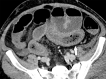 (a) Axial and (b) coronal CT images of the abdomen and pelvis with intravenous contrast material in a 57-year-old man with high clinical suspicion for bowel ischemia. There is generalized small-bowel distension and segmental thickening (white arrows), with adjacent mesenteric congestion (black arrow) and a small volume of ascites (*). Findings are nonspecific but suggestive of early ischemia or infection.