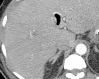 (a) Abdominal radiograph in a 52-year-old man show portal venous gas (arrow), suggestive of bowel infarction. (b) Postoperative CT image also shows portal venous gas (arrow). At laparotomy, bowel ischemia and necrosis are identified, along with an atypical yellow discoloration of the small bowel. (c) Photomicrograph shows submucosal arterioles with fibrin thrombi (arrowheads). The overlying mucosa (upper right) is partially necrotic, with crypt dropout and partial loss of the surface epithelium. (Hematoxylin-eosin stain; original magnification, ×400.)