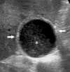 (a) Abdominal US image of an 83-year-old man with an elevated liver enzyme level and sepsis shows a distended gallbladder (arrows) containing sludge (*), suggestive of cholestasis. (b) Intraprocedural US image shows a needle within the gallbladder lumen (arrow), while a cholecystostomy tube is placed with US guidance. Fluid analysis reveals noninfected bile.