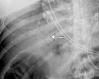 (a) Abdominal radiograph in a 52-year-old man show portal venous gas (arrow), suggestive of bowel infarction. (b) Postoperative CT image also shows portal venous gas (arrow). At laparotomy, bowel ischemia and necrosis are identified, along with an atypical yellow discoloration of the small bowel. (c) Photomicrograph shows submucosal arterioles with fibrin thrombi (arrowheads). The overlying mucosa (upper right) is partially necrotic, with crypt dropout and partial loss of the surface epithelium. (Hematoxylin-eosin stain; original magnification, ×400.)