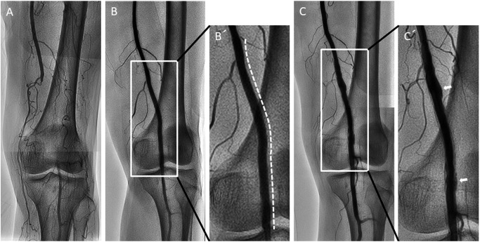 Fig. 1 (A) Angiogram showing total occlusive lesion in the left distal superficial femoral artery to proximal popliteal artery. (B/B′) A 6.0×120 mm Zilver PTX stent was implanted in the occlusive lesion (white dotted line). The stent size was selected to match the vessel size. (C/C′) Angiogram showing peri-stent staining (white arrows) at 21 months after Zilver PTX implantation.