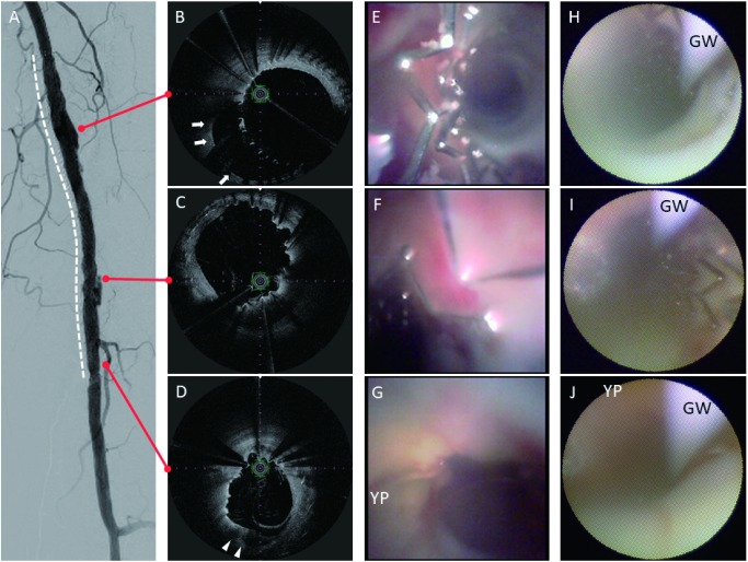 Fig. 2 (A) Digital subtraction image of the Zilver PTX in the femoropopliteal artery (white dotted line). (B–D) Optical frequency domain imaging showing significant positive vessel wall remodeling (white arrows) and heterogeneous low-intensity lipid plaque (white arrowheads). (E–G) Zemporshe angioscopy clearly revealing incomplete stent apposition and stent thrombus. Positive vascular wall remodeling and yellow plaque were more clearly visible compared with that using fiberoptic angioscopy. (H–J) Conventional fiberoptic angioscopy images had noticeably lower resolution and smaller viewing angles than those observed using Zemporshe angioscopy. YP: yellow plaque; GW: guidewire