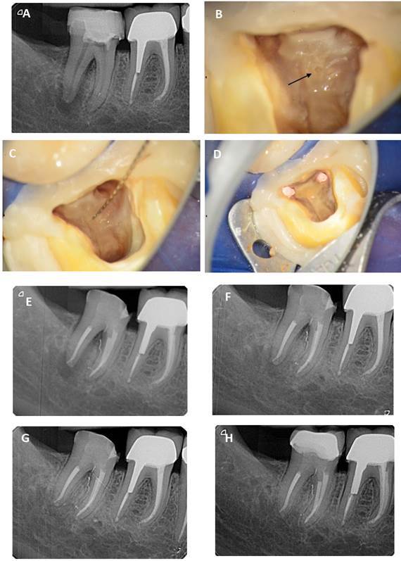 Clinical identification and endodontic management of furcation canals ...