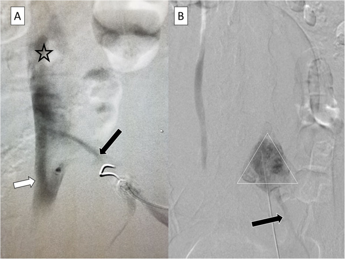 Superior hypogastric nerve block (SHNB) for pain control after uterine ...