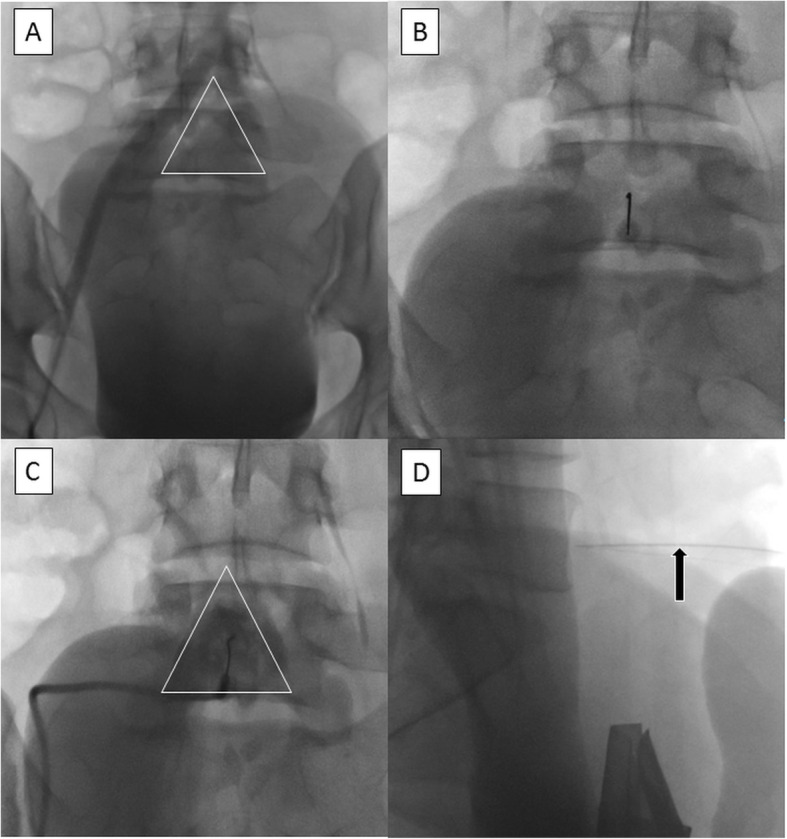 Superior hypogastric nerve block (SHNB) for pain control after uterine ...