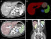 Example of abdominal organ segmentation, with each color representing
different organs. (A) Axial CT DICOM image demonstrates a splenic laceration
(arrow). (B) Image illustrates the segmentations for the liver (red), spleen
(green), left kidney (blue), and gastrointestinal tract (brown) in the axial
plane. (C) Image shows segmentation masks overlaying the corresponding CT image.
(D) Image shows segmentation masks overlaying the corresponding organs on a
reconstructed coronal CT DICOM image. DICOM = Digital Imaging and Communications
in Medicine.