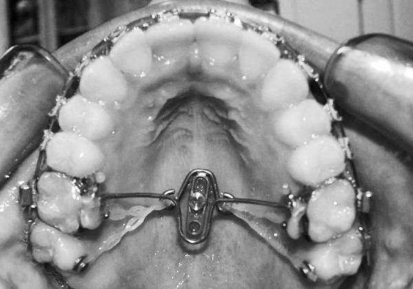 Figure 2. Elastomeric traction applied from a single midpalatal mini-implant with a dumbbell attachment to a transpalatal arch and second molars.