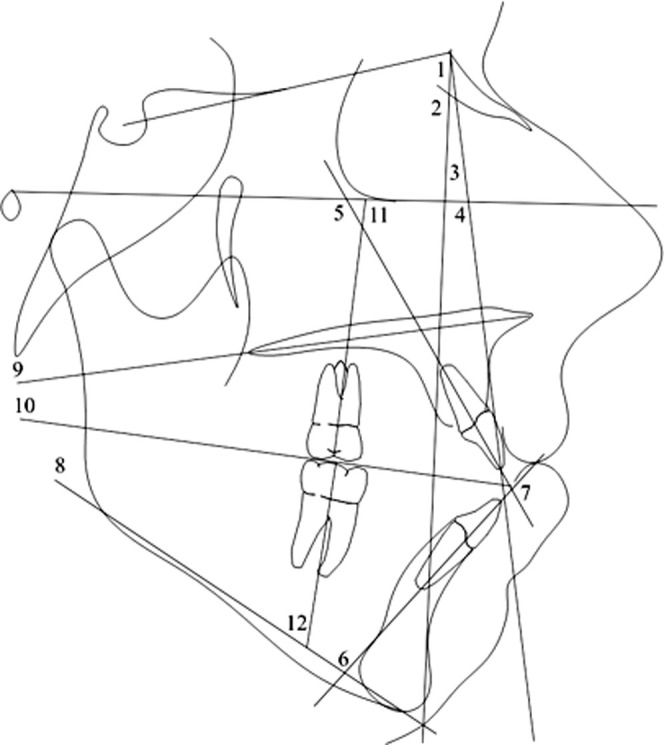 Figure 3. Angular cephalometric measurements (degrees): 1  =  SNA, 2  =  SNB, 3  =  ANB, 4  =  FH-NA, 5  =  U1-FH, 6  =  L1-MP, 7  =  U1-L1, 8  =  MP-FH, 9  =  PP-SN, 10  =  OP-SN, 11  =  U6-FH, 12  =  L6-MP. Not shown: U7-FH, L7-MP.