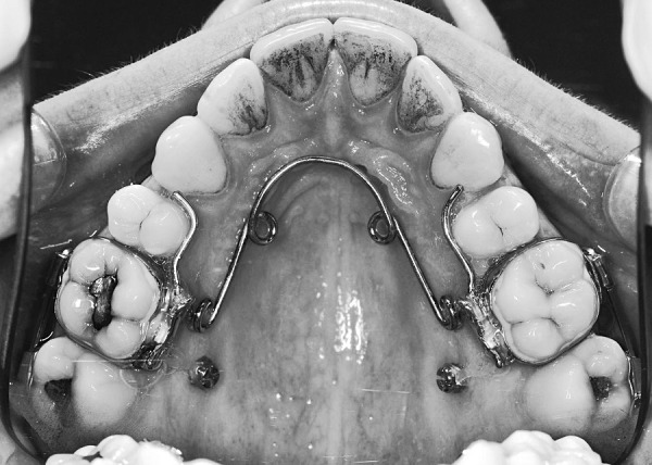 Figure 1. Elastomeric traction applied from bilateral palatal (alveolar) mini-implants to a quad helix appliance. The maxillary second molars have been bonded as part of bilateral sectional fixed appliances.