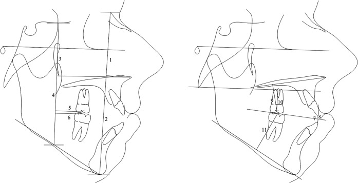 Figure 4. Linear cephalometric measurements (mm): 1  =  LFH (ANS-Me), 2  =  TFH (N-Me), 3  =  PLFH (ANS-MP), 4  =  PTFH (SES-MP), 5  =  U6-PTM, 6  =  L6-PTM, 7  =  OB, 8  =  OJ, 9  =  U6-PP, 10  =  U6-Ba, 11  =  L6-MP. Not shown: U7-PTM, L7-PTM, U7-PP, U7-Ba, L7-MP.