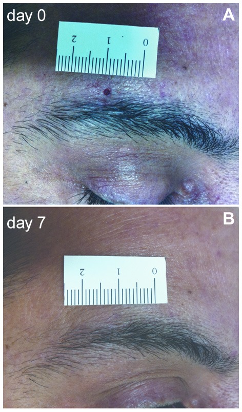 Differential myelinated and unmyelinated sensory and autonomic skin ...