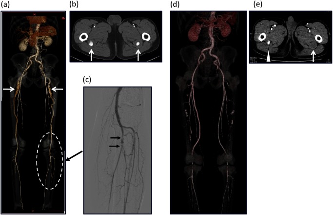 Fig. 3 (a) Preoperative CT showing a complete PSA with aneurysm formation and an incomplete superficial femoral artery that does not reach the popliteal artery. (b) CT showing an aneurysm that extends for 30 mm. (c) Angiography showing a filling defect of the left tibioperoneal trunk. (d) Postoperative CT showing a patent bilateral femoropopliteal bypass graft. (e) A left PSA aneurysm is completely excluded (arrow). Retrograde flow into right PSA aneurysm persists (arrowhead).