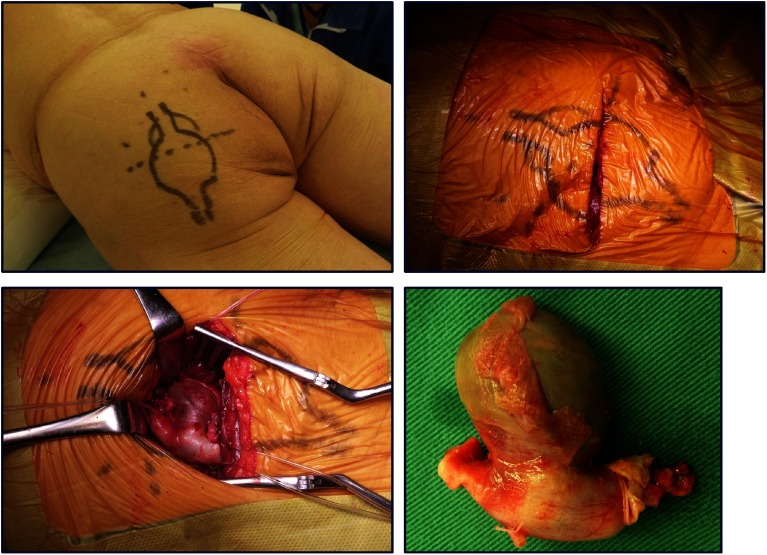 Fig. 2 Intraoperative findings following a transverse incision of the left buttock and resected persistent sciatic artery aneurysm.