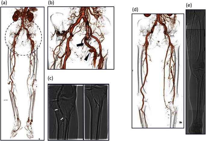 Fig. 1 (a) CT showing a fusiform aneurysmal dilation and occluded PSA. The popliteal artery was fed by collateral circulation. (b) PSA (arrow) and fusiform aneurysmal dilation of PSA (arrowhead). (c) Filling defects of the popliteal artery were detected below the knee. Endovascular treatment of distal embolization from a PSA aneurysm had been performed three times. (d) Postoperative computed tomography showing a patent bypass graft. (e) Postoperative angiography showing a patent bypass graft.