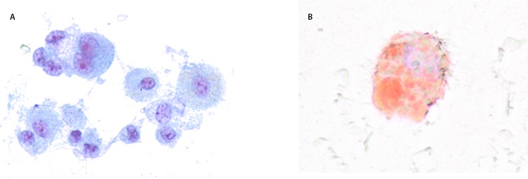 The figure shows microscopy of a bronchoalveolar lavage sample (Papanicolaou stain and oil red O stain) from a patient with acute lung injury associated with vaping in North Carolina, during July–August 2019.